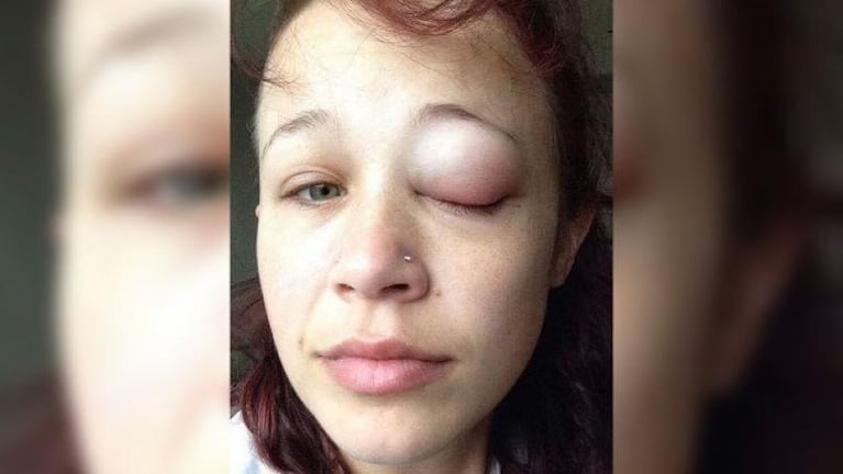 Grave error: una modelo perdió la vista al tatuarse un ojo