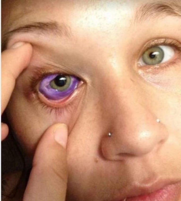 Grave error: una modelo perdió la vista al tatuarse un ojo