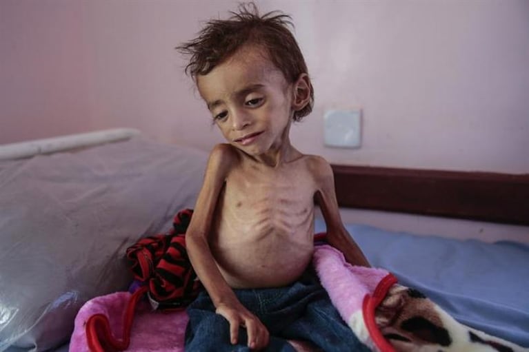 Hambruna en Yemen: murió por desnutrición la nena que fue símbolo de guerra