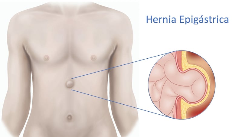 Hernia epigástrica.