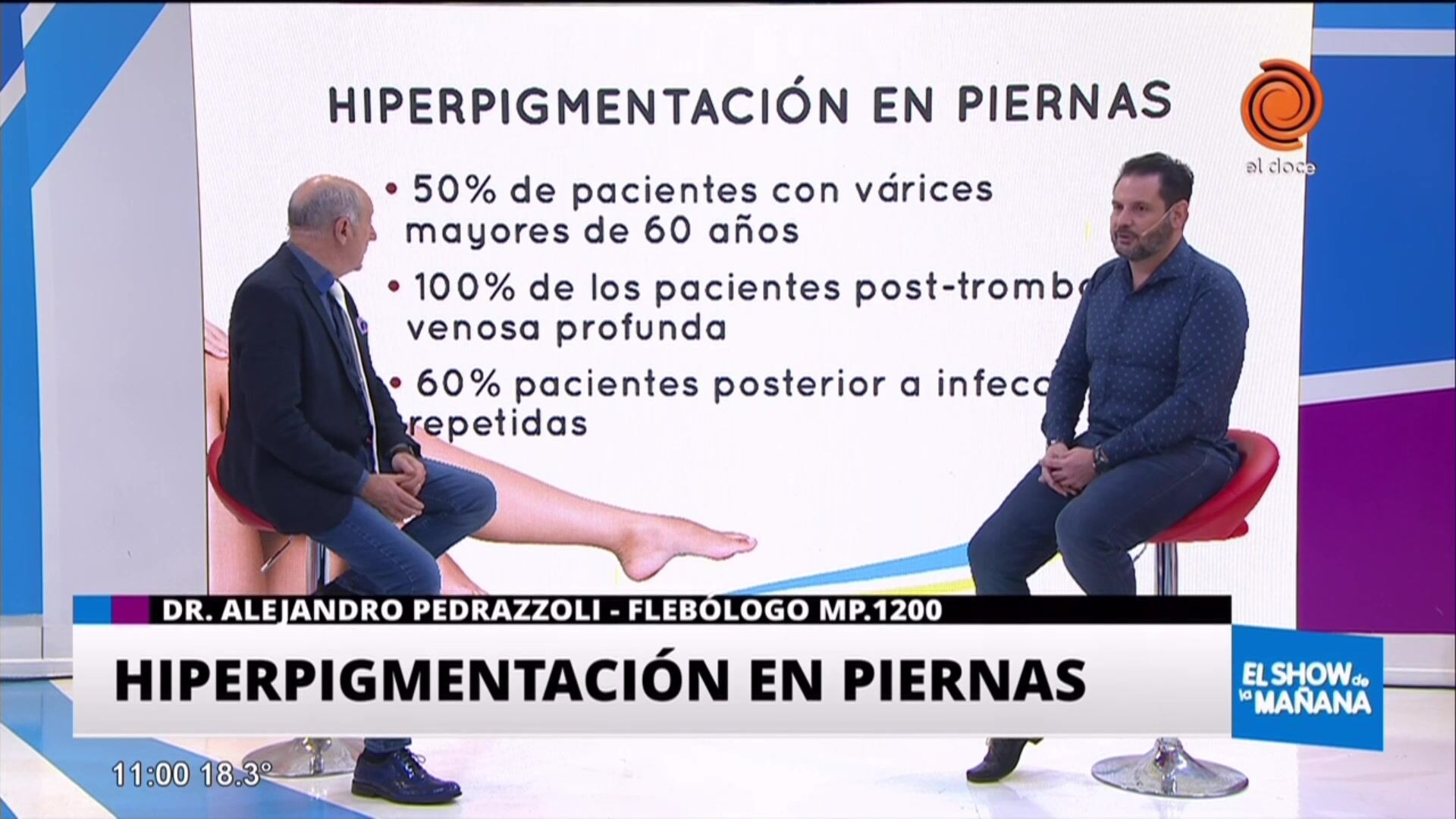 Hiperpigmentacion en piernas