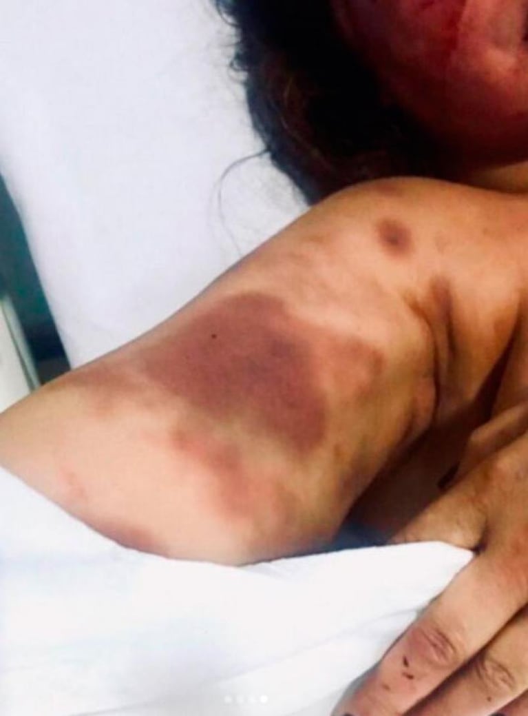 Horror en Río de Janeiro: la golpeó, mordió e insultó en la primera cita