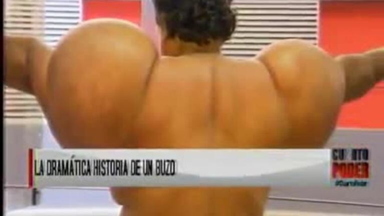 La impresionante deformación de un buzo