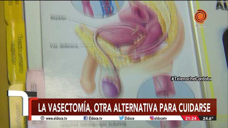 Cómo es una operación de vasectomía