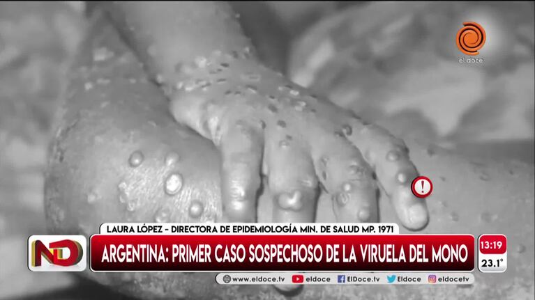 Viruela del mono: cuáles son los síntomas y cómo se transmite