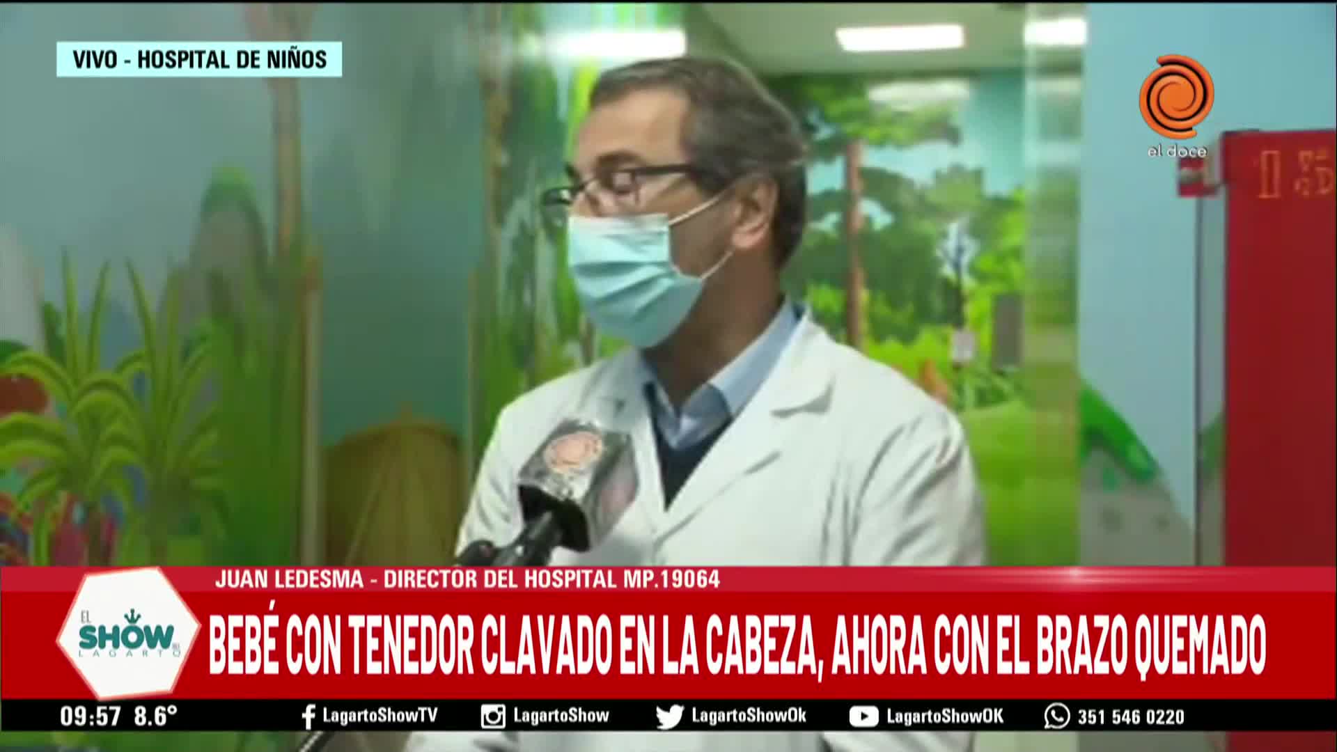 El bebé herido con un tenedor ahora sufrió quemaduras en su mano