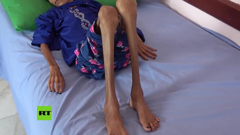 El video de la niña desnutrida que conmueve a Yemen
