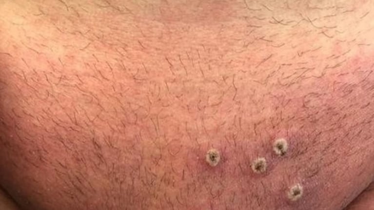 Viruela del mono: ¿es posible que derive en una nueva pandemia?