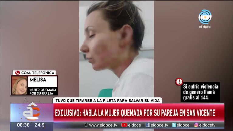 Su ex la prendió fuego y contó cómo fue el ataque