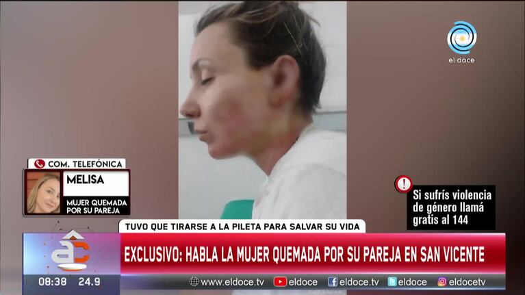 Su ex la prendió fuego y contó cómo fue el ataque