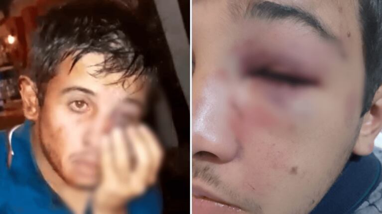“Me agarraron a patadas sin piedad”: el estremecedor relato del joven atacado por una patota en un boliche