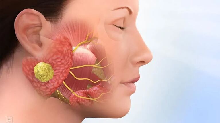 Las señales de un extraño tumor benigno que afecta las glándulas salivales