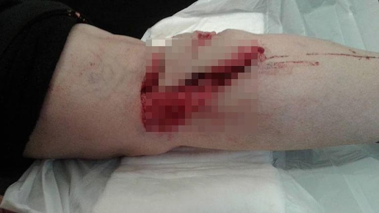 Huerta Grande: un perro pitbull atacó a una abuela y le destrozó la pierna