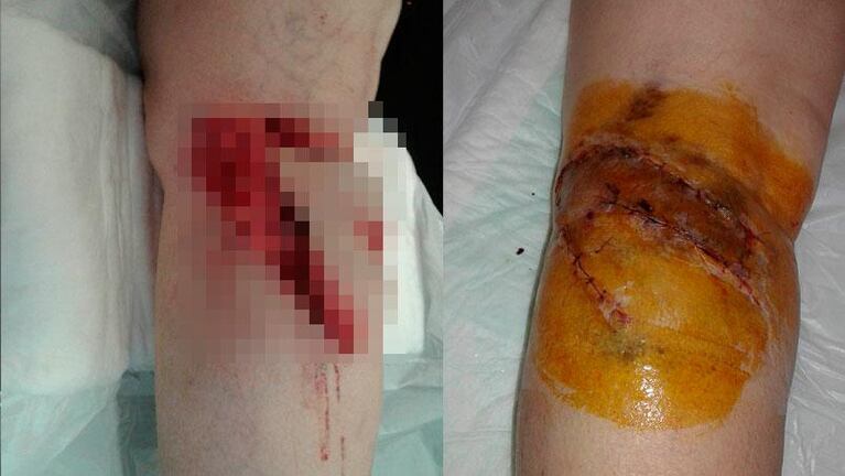 Huerta Grande: un perro pitbull atacó a una abuela y le destrozó la pierna