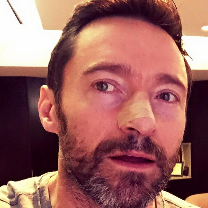 Hugh Jackman y su cáncer de piel:  ¡usen protectores solares! 