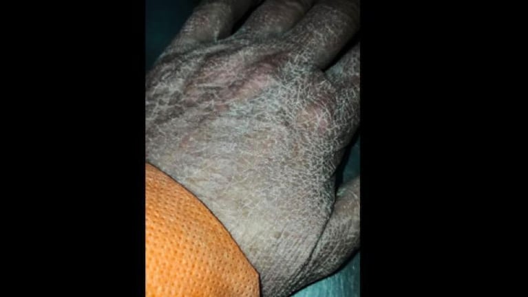 Impactante: así luce la mano de una enfermera santafesina tras largas horas de trabajo