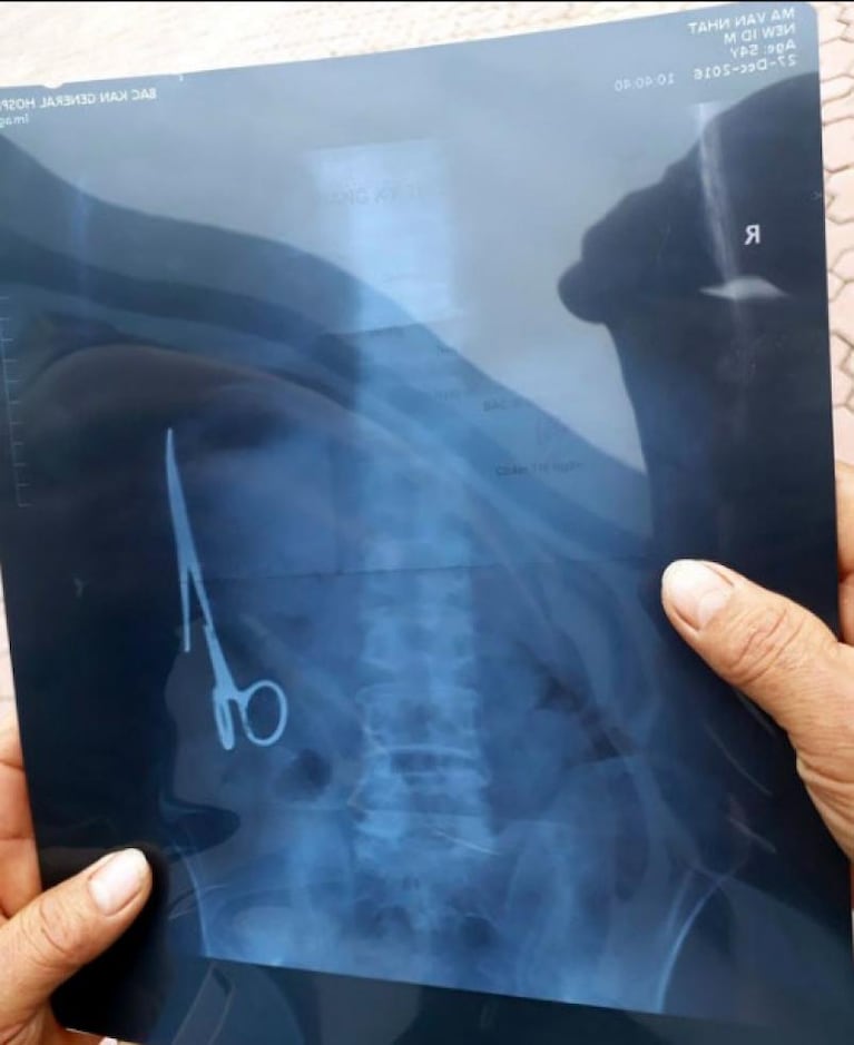 Insólito: vivió 18 años con una tijera en su estómago 