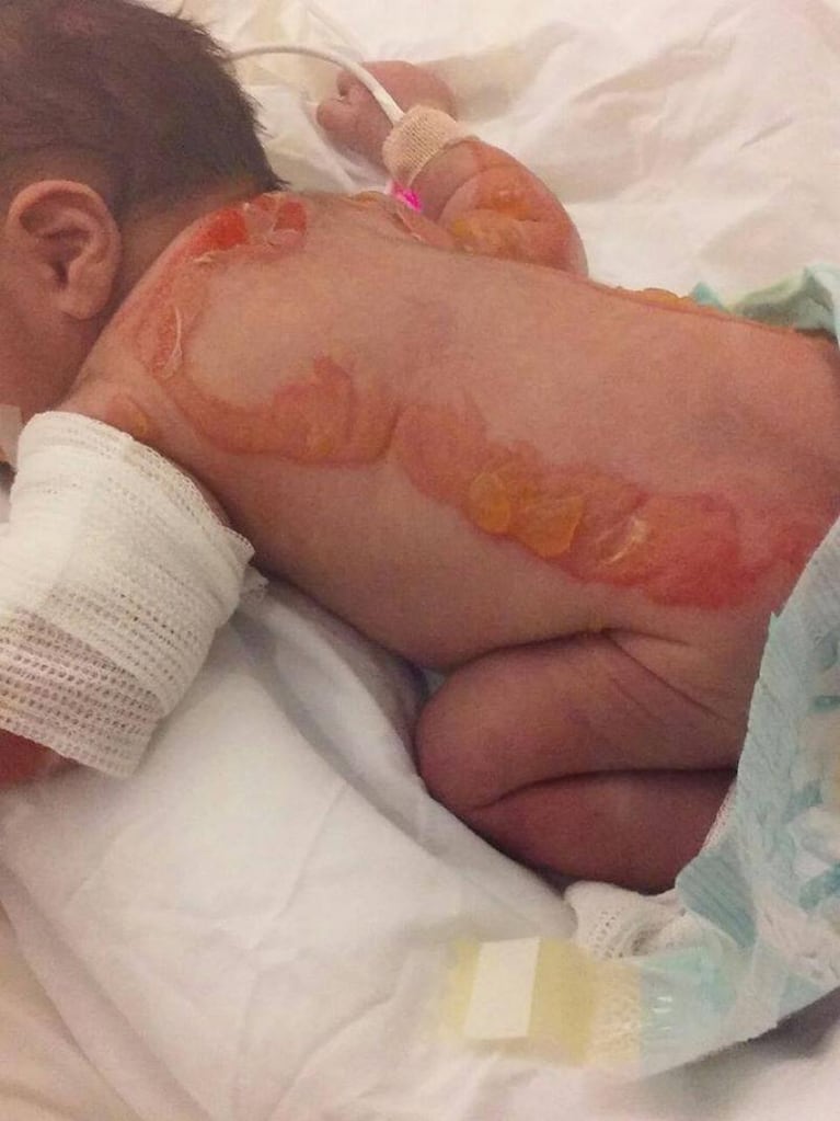 Investigan las quemaduras de un bebé