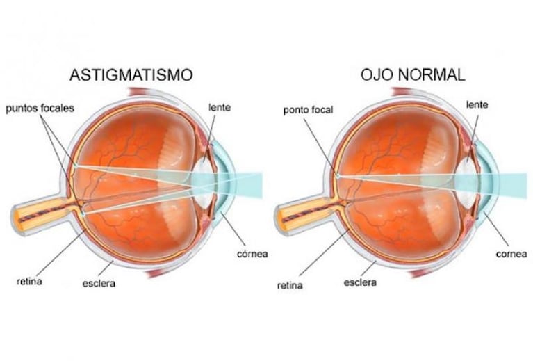 Julieta Silva sufre un alto grado de astigmatismo