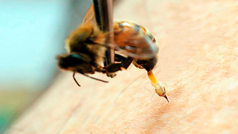 La acupuntura con picaduras de abejas es una técnica cada vez más disponible en el mundo.