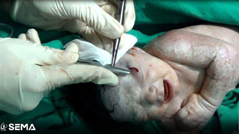 La beba siria estaba en el vientre de su madre cuando bombardearon su casa.