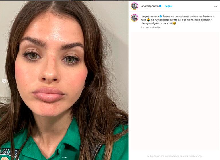 La China Suárez contó en Instagram qué le pasó en la cara.