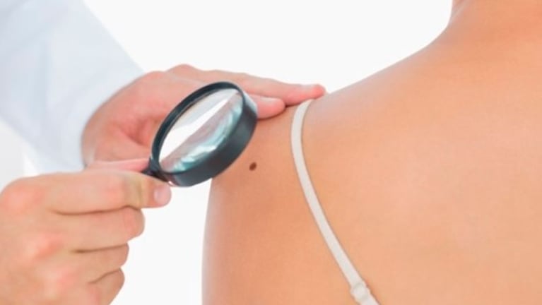 La detección temprana es fundamental para tratar el cáncer de piel.
