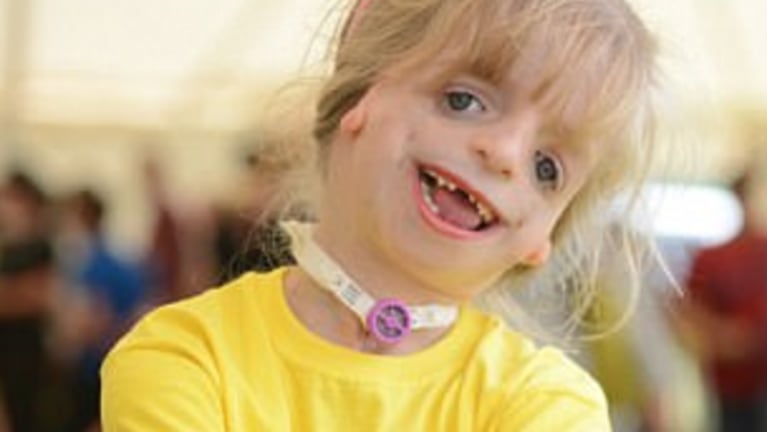 La historia de superación de una niña operada 29 veces del rostro