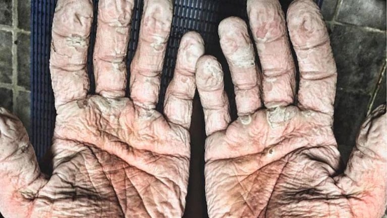 La impactante foto de las manos arruinadas de un expedicionario