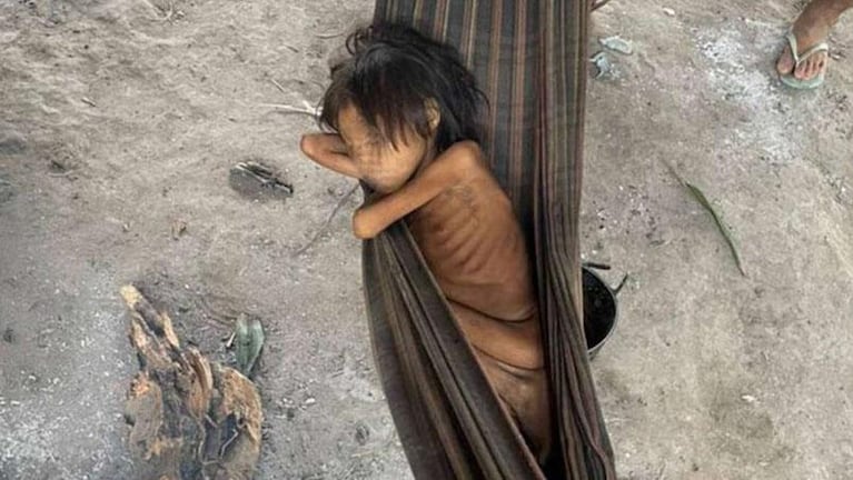 La impactante foto de una nena en Brasil: tiene 8 años y solo pesa 12 kilos