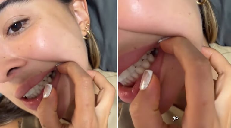 La joven contó que la sorpresa de su novio le rompió un diente.