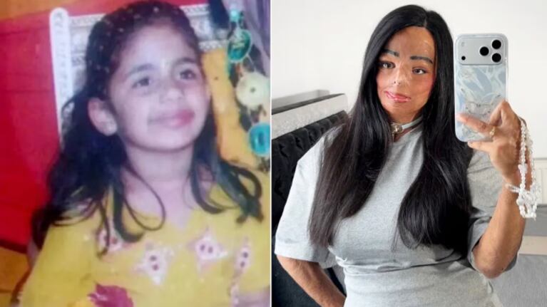 La joven de 21 años aún se hace injertos en el cuerpo.
