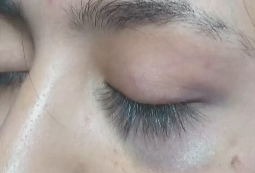 La joven mostró su ojo morado  y otras lesiones en el cuerpo.