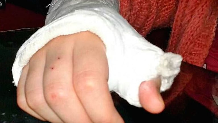 La mano de la menor enyesada, tras el violento ataque que sufrió en la escuela.
