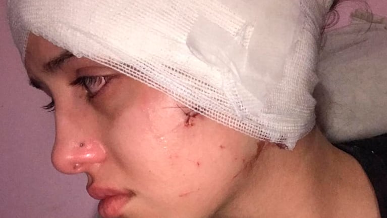 La moza agredida en un bar recibió 20 puntos de sutura por el corte en su oreja.