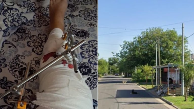 La mujer sufrió una grave fractura.