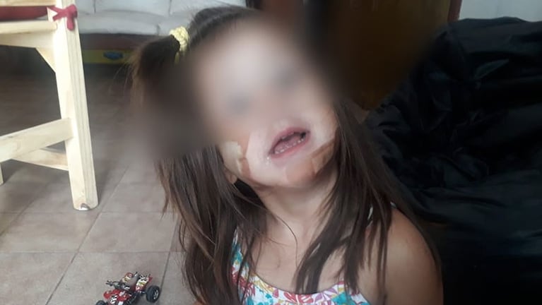 La niña quedó con lesiones que demandarán cuidado intensivo.