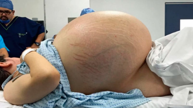 La paciente llegó al Hospital muy acomplejada por el tamaño de su panza.