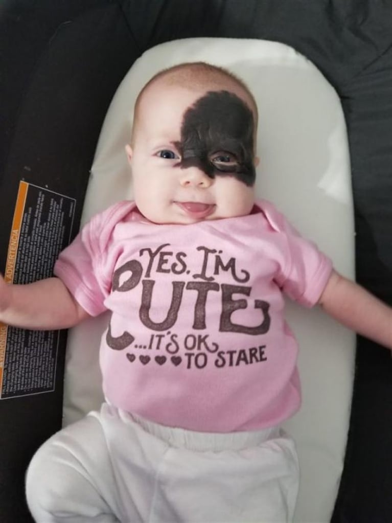 La pequeña superheroína que nació con una mancha en su rostro