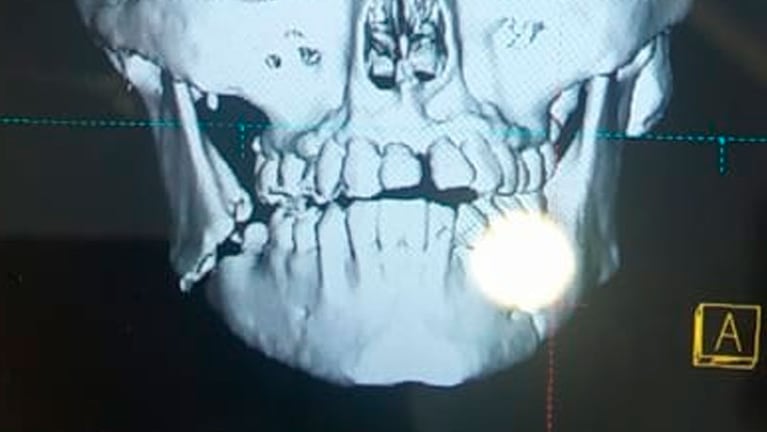La placa muestra claramente la doble fractura de mandíbula de la víctima del intento de robo.