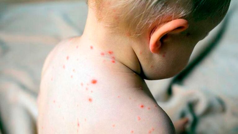 La prevención del sarampión se da con la vacuna triple viral.