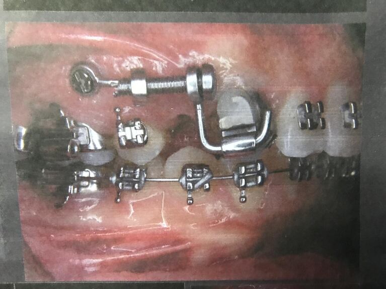 La UNC creó un nuevo sistema de ortodoncia