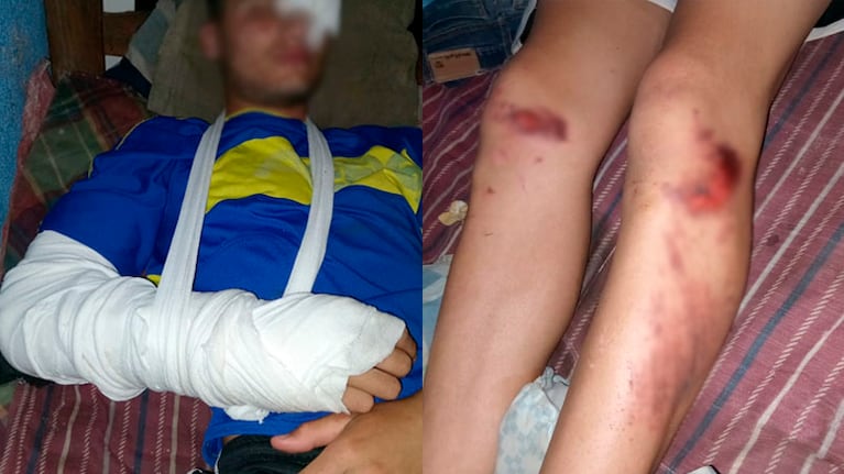 La víctima de 16 años sufrió lesiones tras ser atropellado.