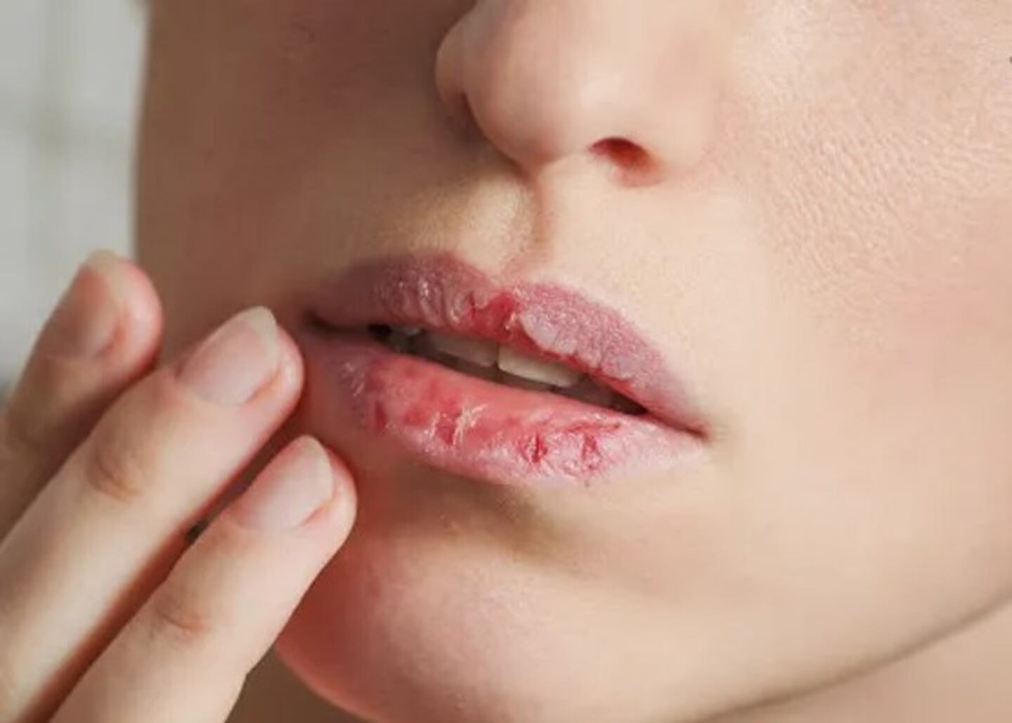 labios resecos salud