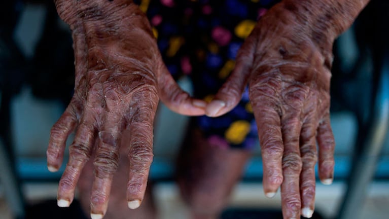 Las escamas afectan toda la piel de Shalini. Fotos: AFP.