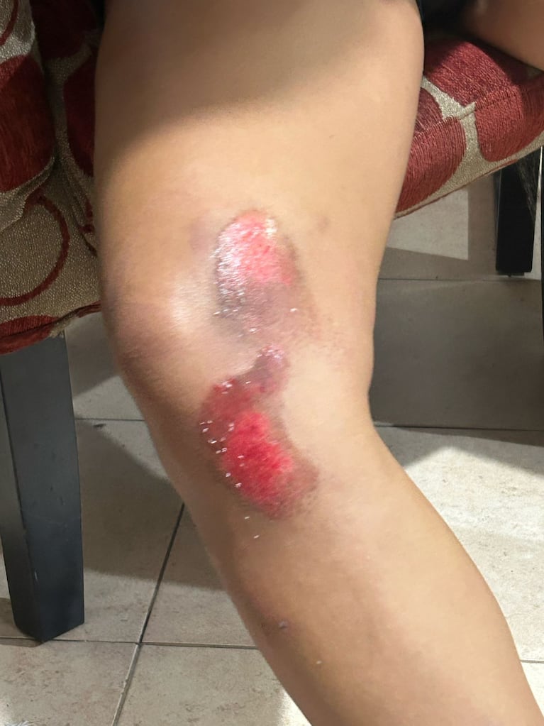Las heridas que sufrió una joven asaltada por motochoros.
