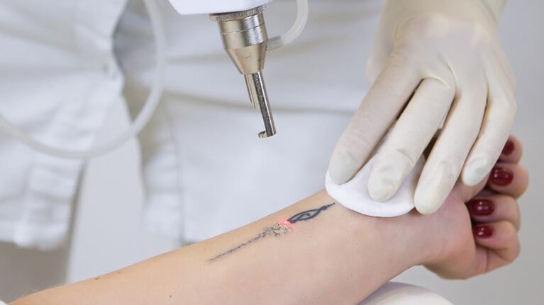 Las remociones de tatuajes son cada vez más frecuentes.