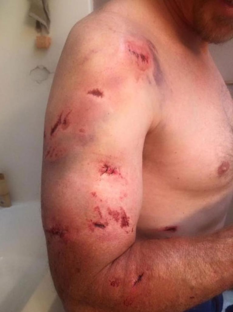 Las terribles heridas del cazador que fue atacado por una osa