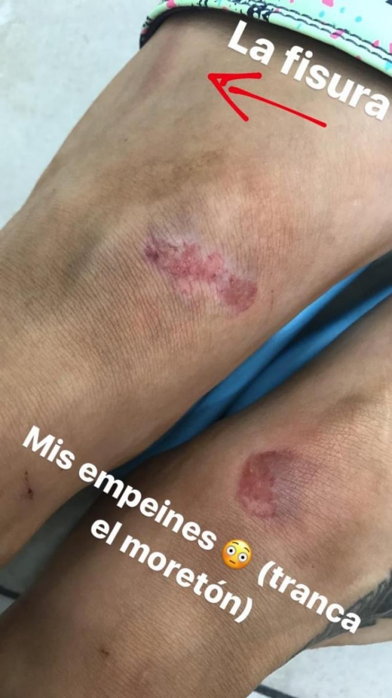 Las tremendas fotos de la lesión de Jimena Barón 