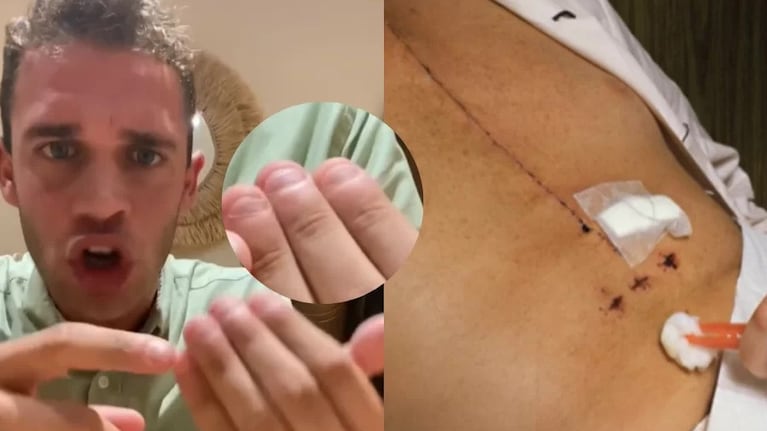Lo operaron del corazón por morderse las uñas.